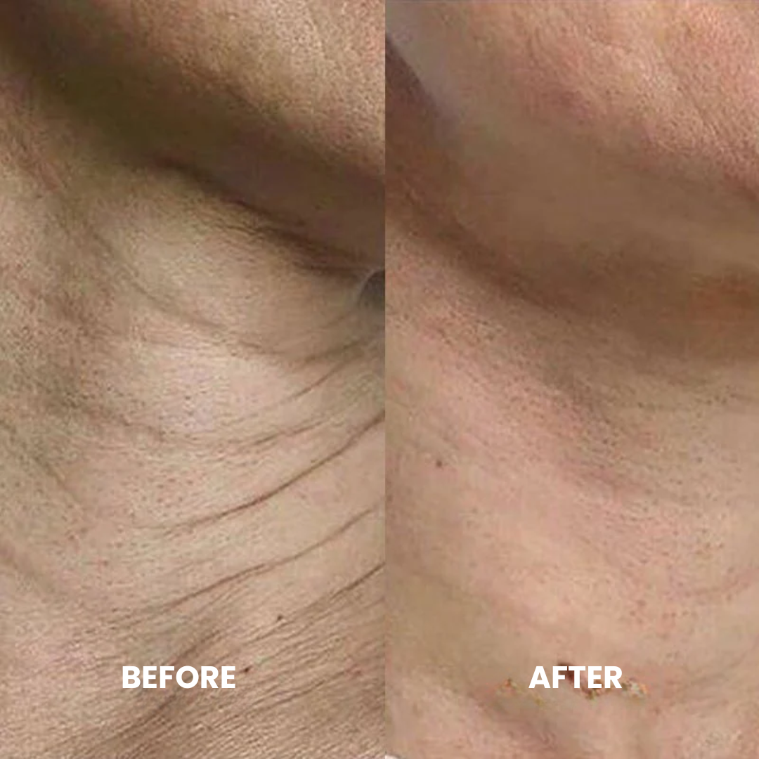 Luxe Micro Infusion System™